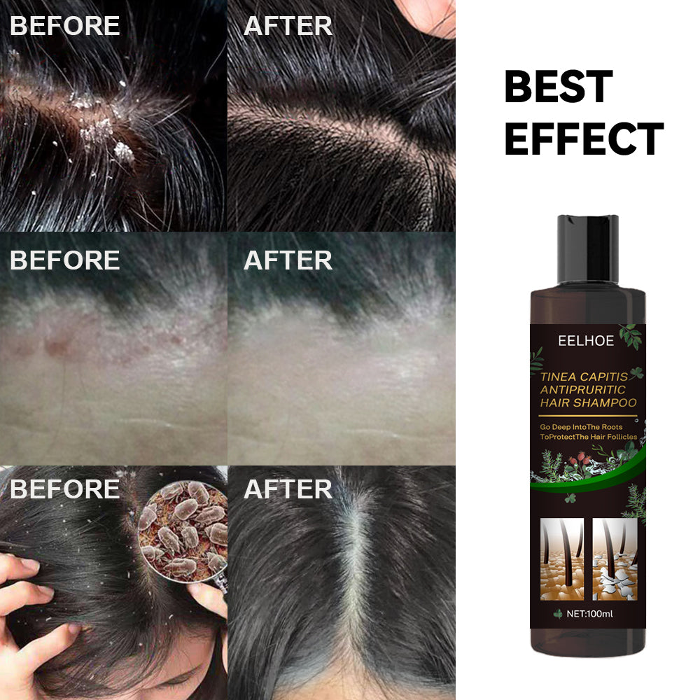 EELHOE Tinea Capitis Anti-Itch Shampoo Anti-Drop Refreshing Oil Control Hair Care Anti-Dandruff Anti-Itch Shampoo