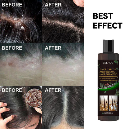 EELHOE Tinea Capitis Anti-Itch Shampoo Anti-Drop Refreshing Oil Control Hair Care Anti-Dandruff Anti-Itch Shampoo